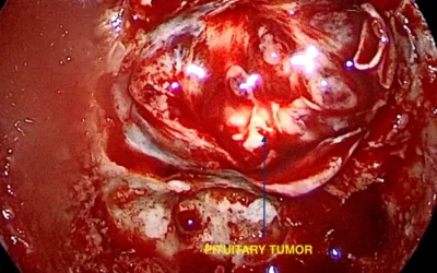 Pituitary Tumors