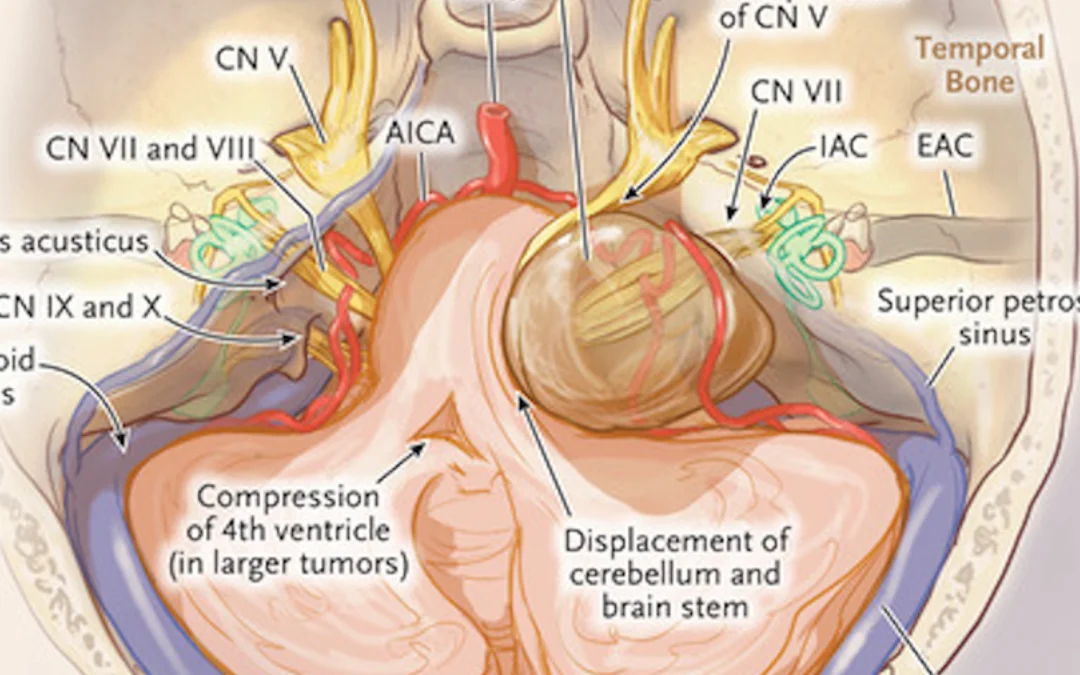 Vestibular Schwannoma/ Acoustic Neuroma