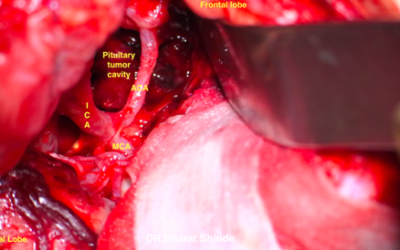 Minimal Invasive Spine Surgery