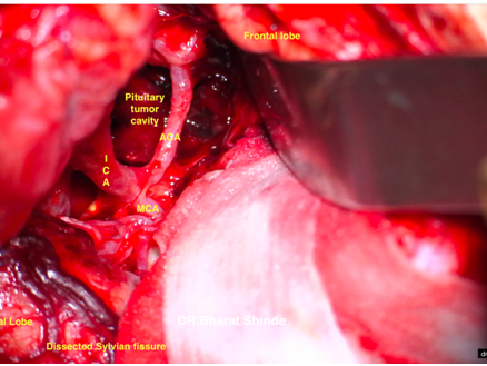 Minimal Invasive Spine Surgery