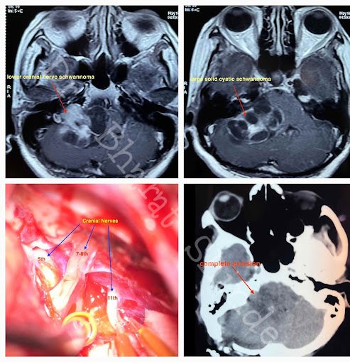 Lower Cranial Nerve Schwannoma