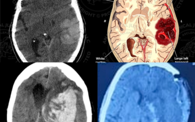 Understanding Intracranial Hematoma (ICH) and the Role of Surgery: Insights from a Neurosurgeon in Thane