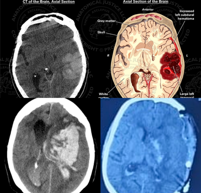 Understanding Intracranial Hematoma (ICH) and the Role of Surgery: Insights from a Neurosurgeon in Thane