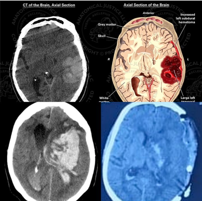 Understanding Intracranial Hematoma (ICH) and the Role of Surgery: Insights from a Neurosurgeon in Thane