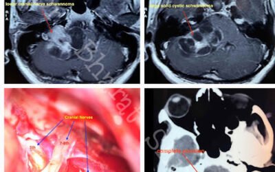 Lower Cranial Nerve Schwannoma
