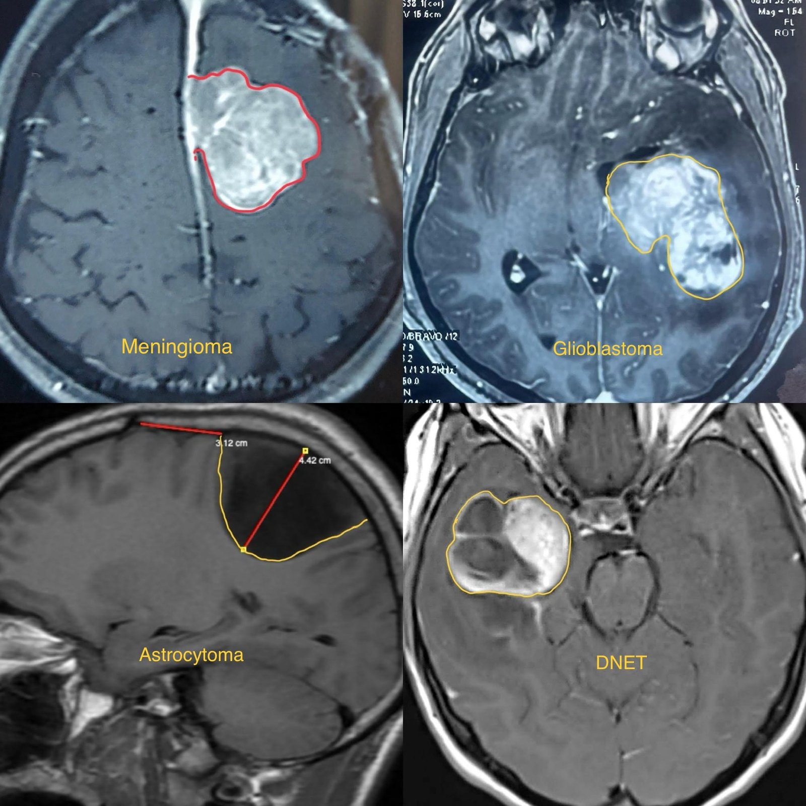 Brain Tumors