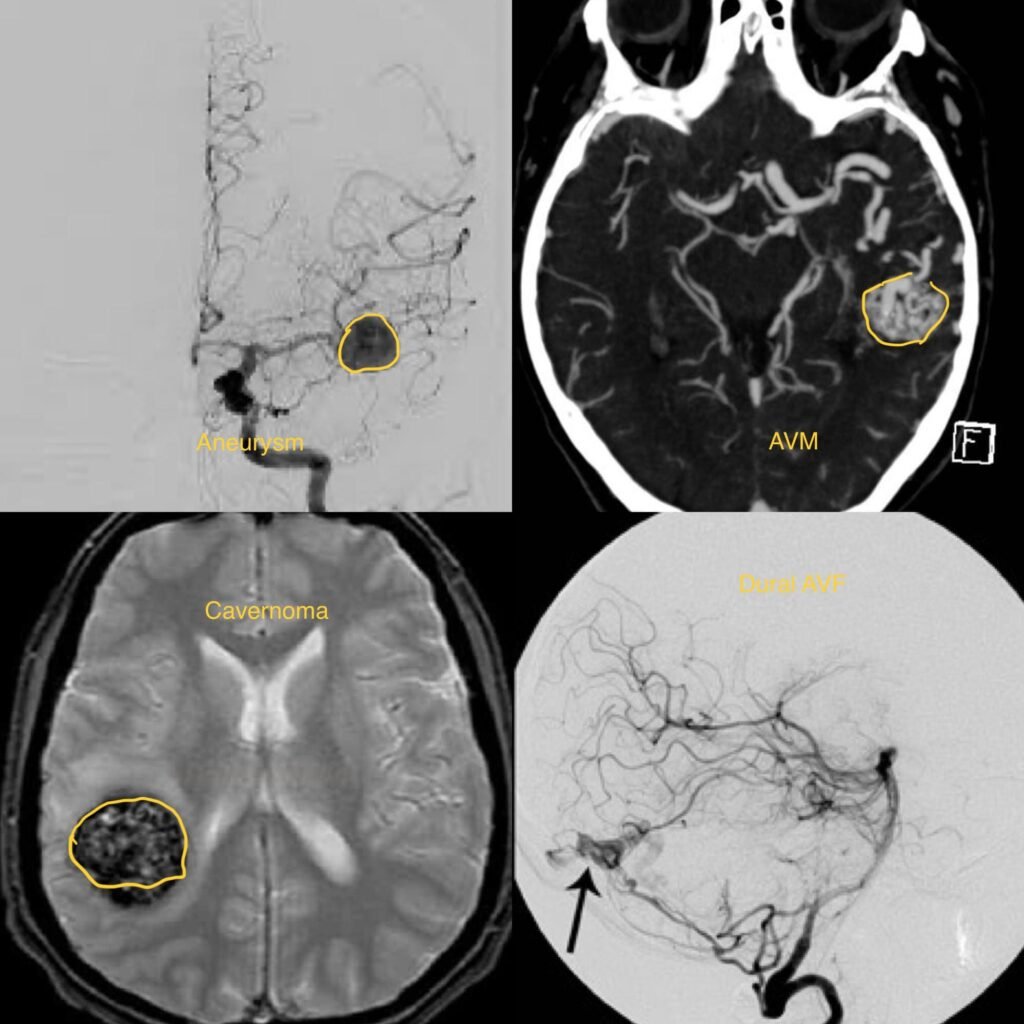 Cerebrovascular Diseases