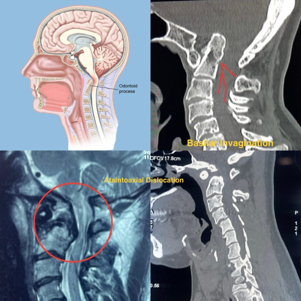 Craniovertebral Junction Anomalies