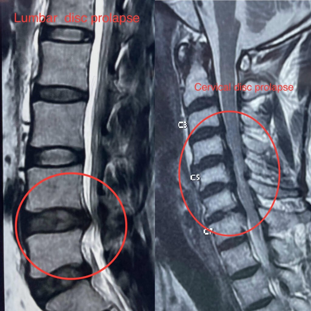 Disc Prolapse