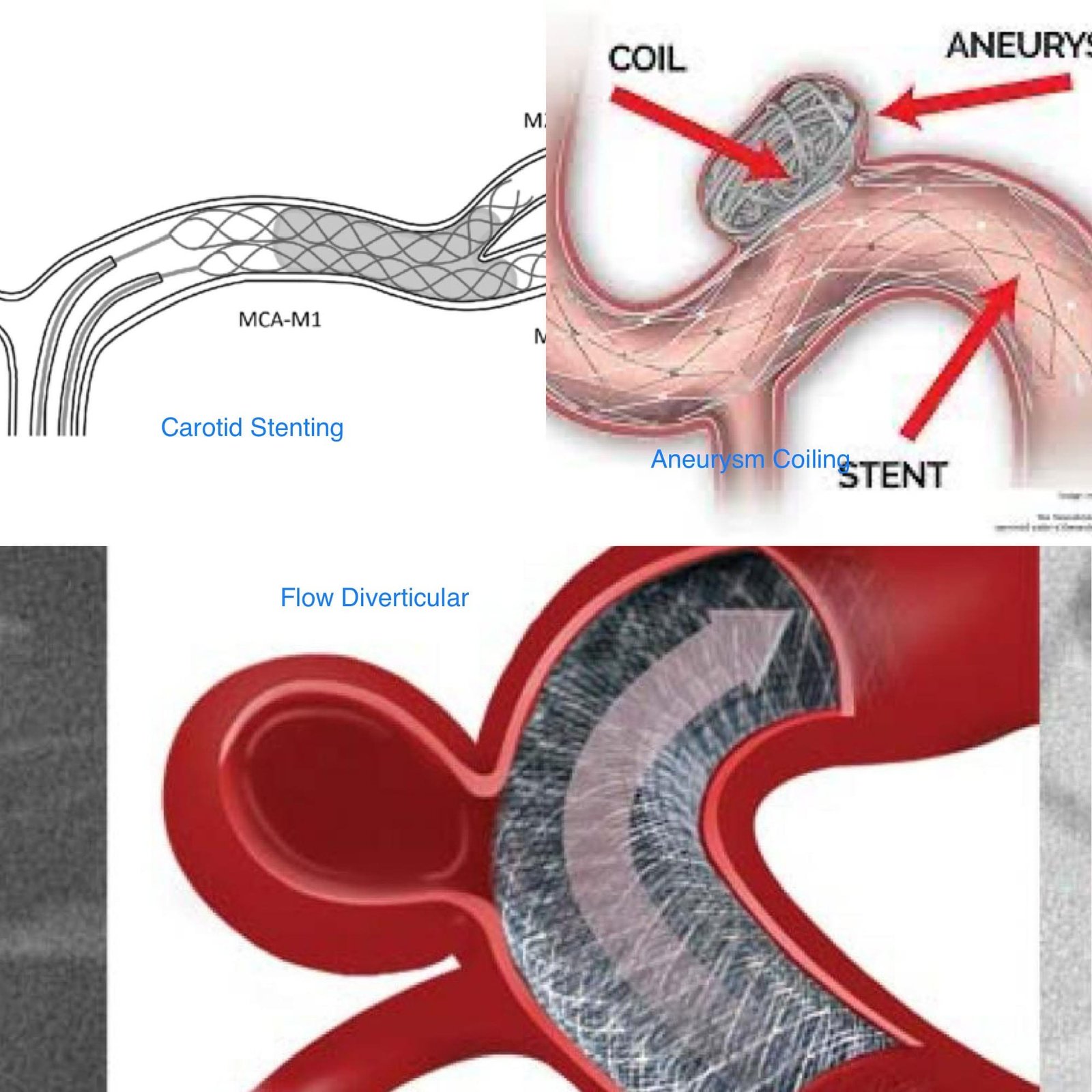 Endovascular Procedurs