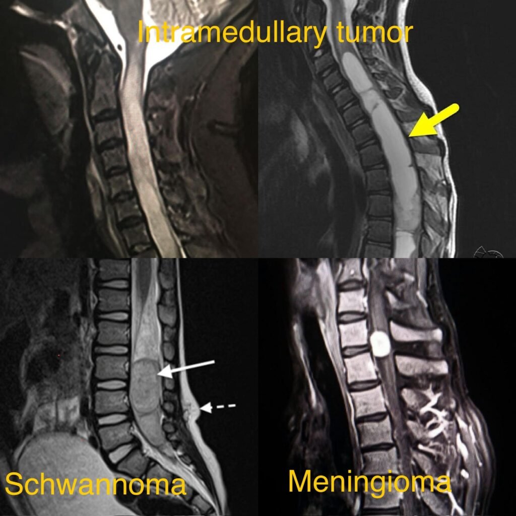 Intramedullary Tumor