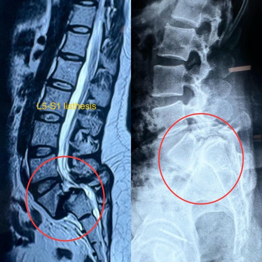 Listhesis