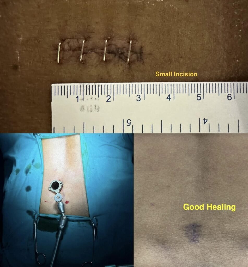 Minimal Invasive Endoscopic Spine Surgery