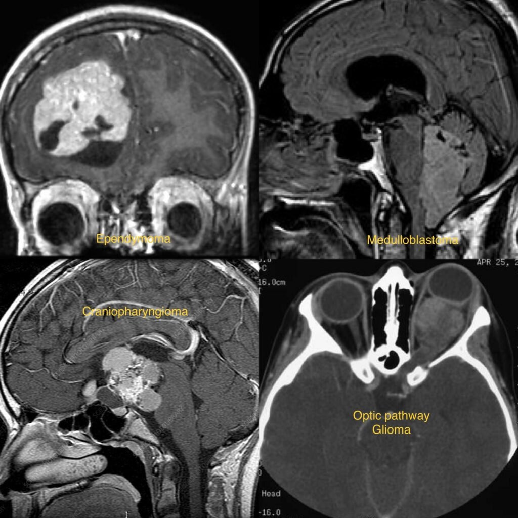Pediatric Brain Tumors