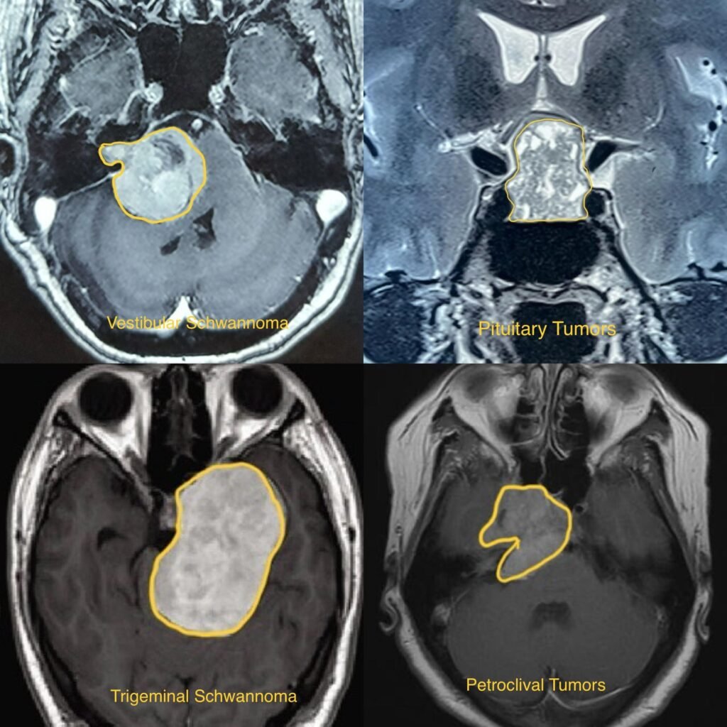 Skullbase Tumors