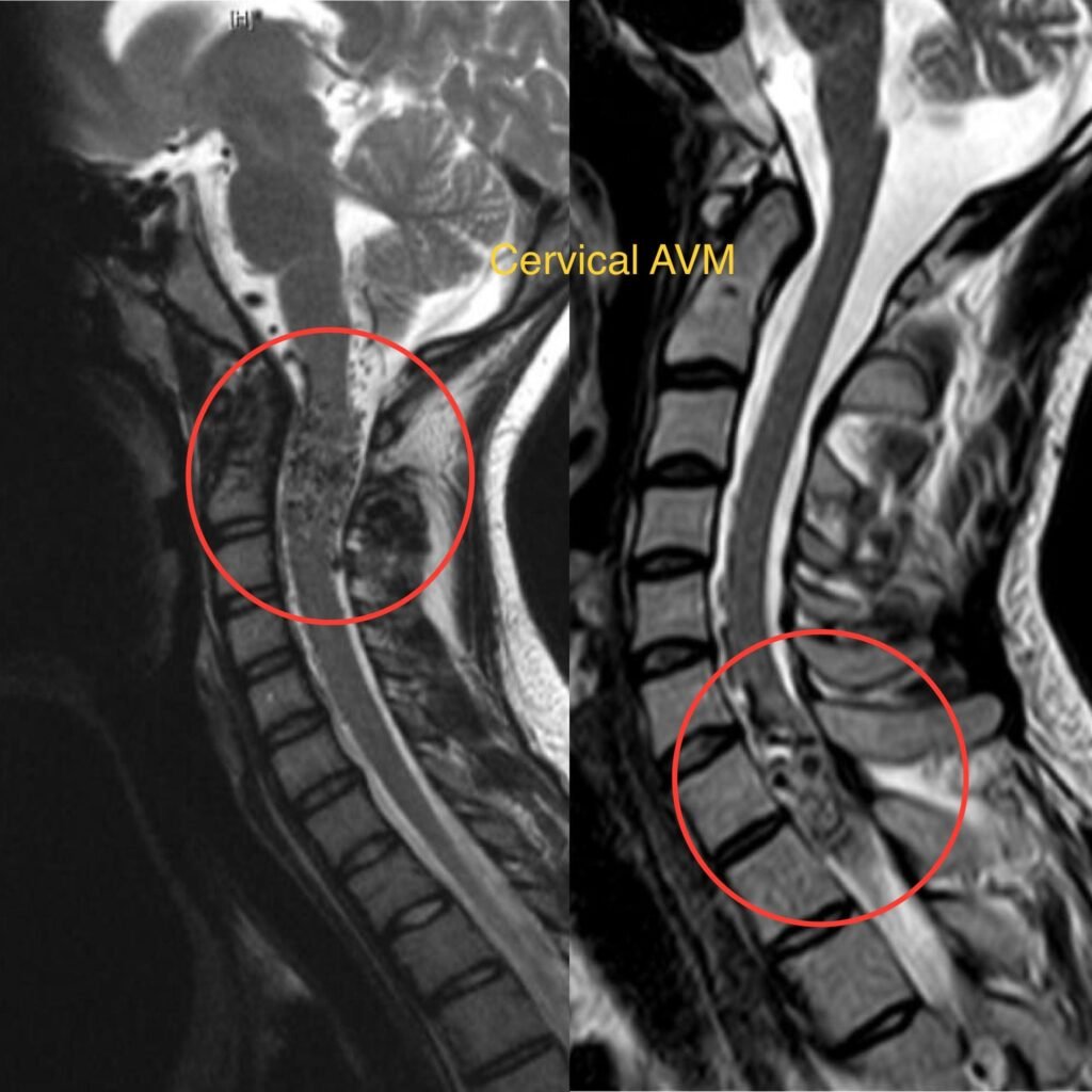 Spinal Arteriovenous Malformation