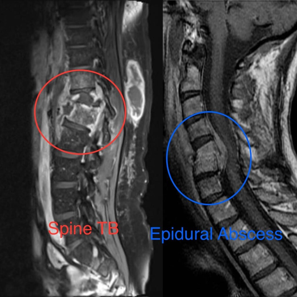 Spinal Infections
