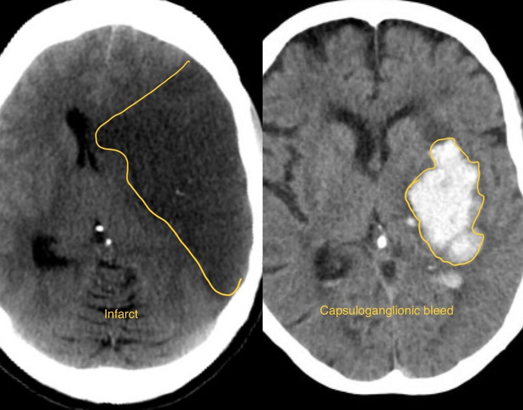 Stroke Surgery