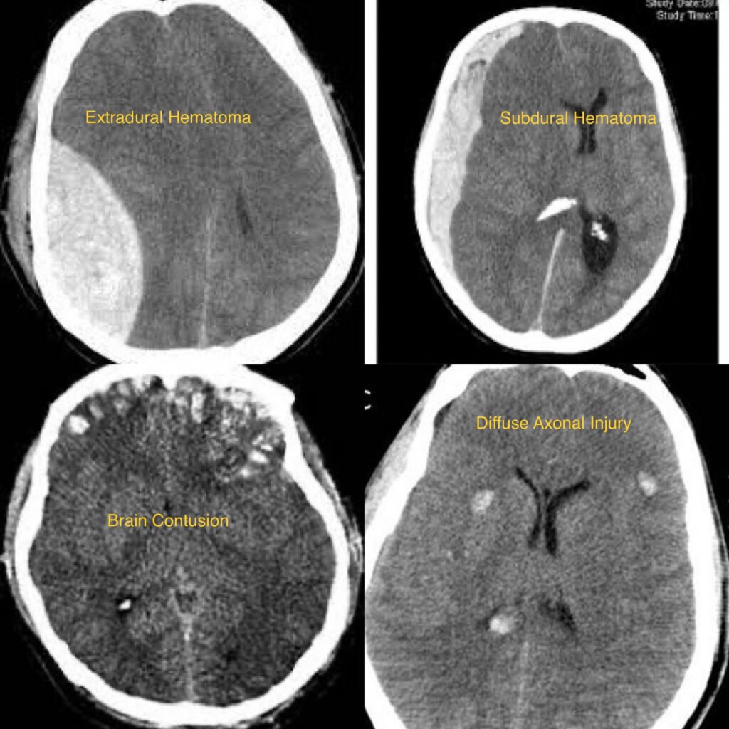 Traumatic Brain Injury