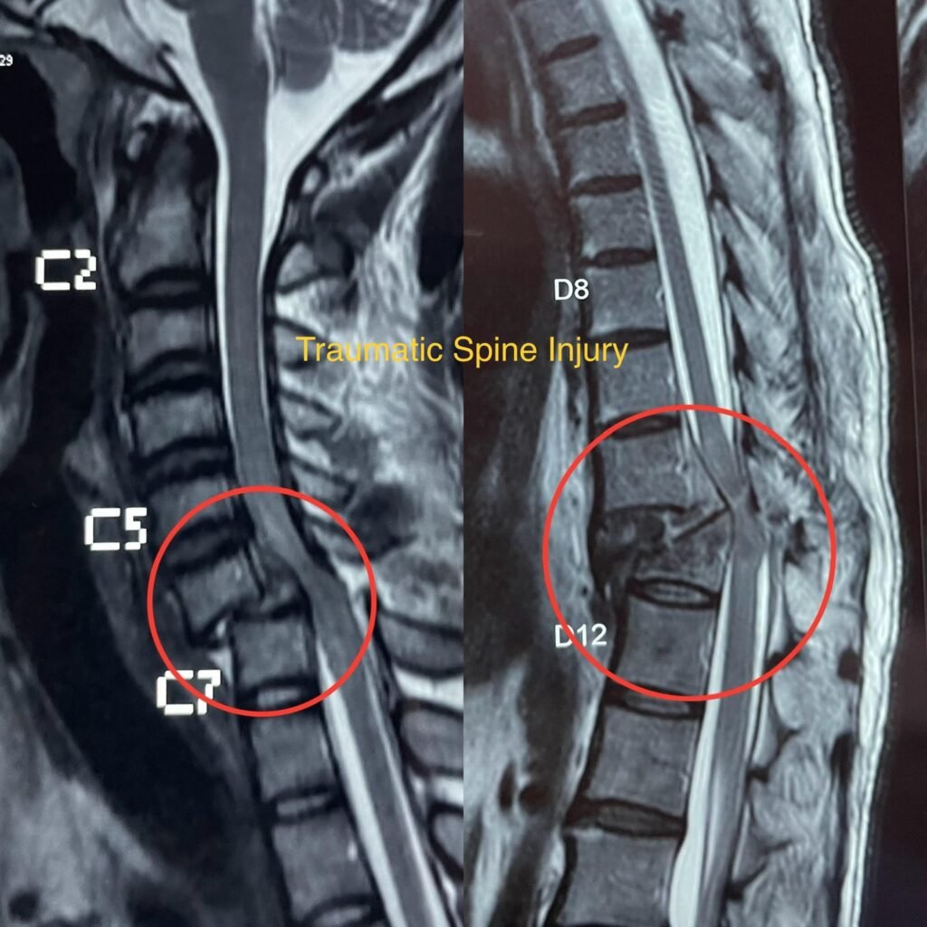 Traumatic Spine Injury