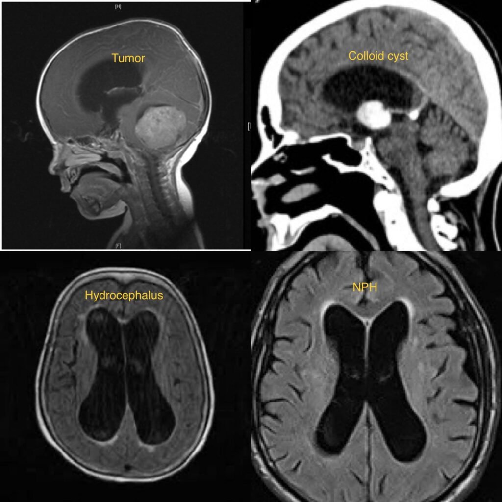 Ventricular Brain Tumors