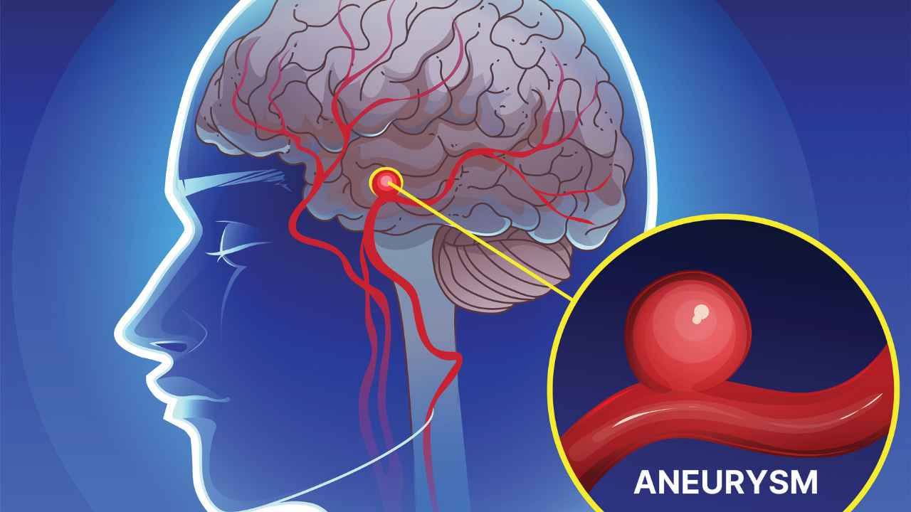 Brain Aneurysm Early Warning Signs
