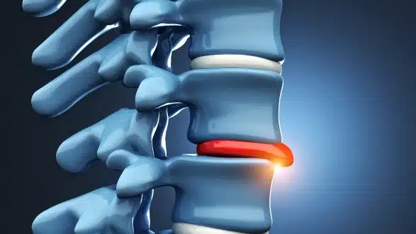 Lumbar Spinal Stenosis: Causes, Symptoms & Modern
